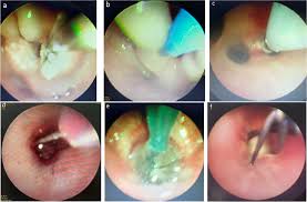 Bronchoscopy For Foreign Body Bronchus Main Image